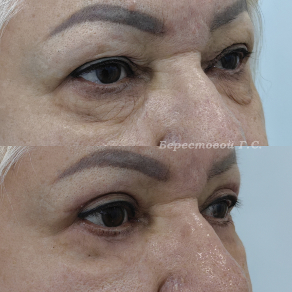 Круговая блефаропластика (3 месяца после операции)
