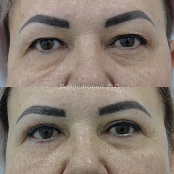 Круговая блефаропластика (3 месяца после операции)