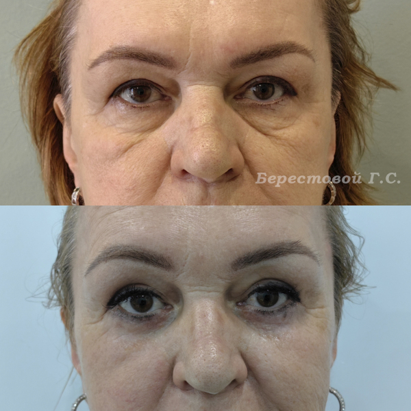 Нижняя блефаропластика (3 месяца после операции)
