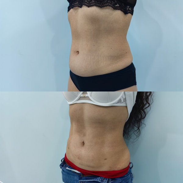 Ультразвуковая липосакция Vaser