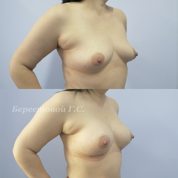 Увеличение груди круглыми имплантами