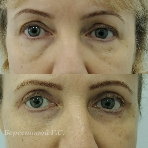 Верхняя блефаропластика (месяц после операции)