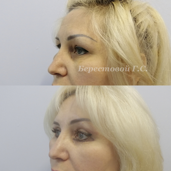 Верхняя блефаропластика (3 месяца после операции)