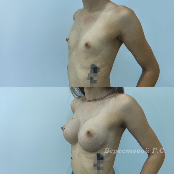 Увеличение груди анатомическими имплантами