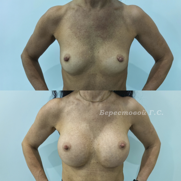 Увеличение груди круглыми имплантами