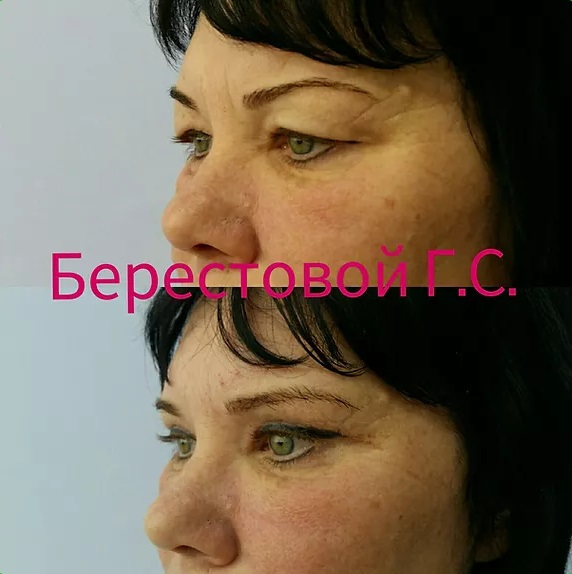 Верхняя блефаропластика