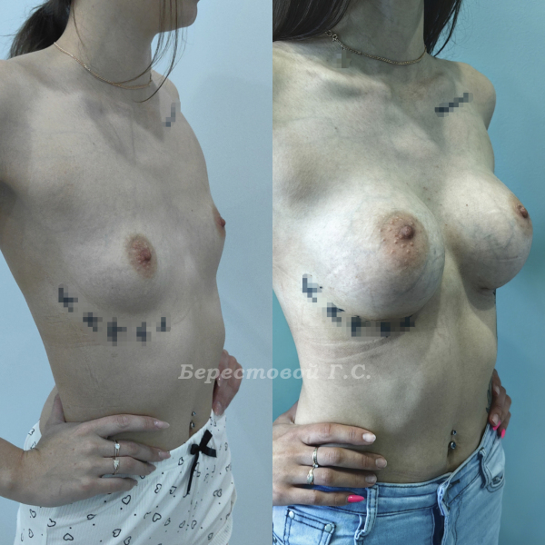 Увеличение груди круглыми имплантами