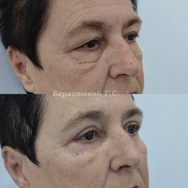 Круговая блефаропластика (3 месяца после операции)