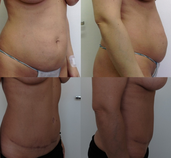 Абдоминопластика