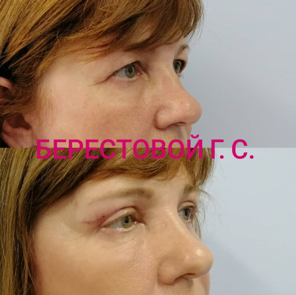 Верхняя блефаропластика (2недели после операции)