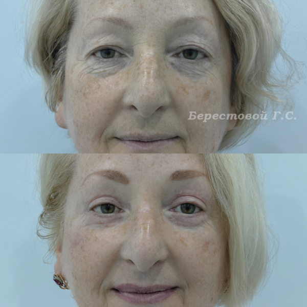 Круговая блефаропластика (3 месяца после операции)