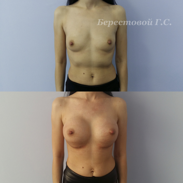 Увеличение груди круглыми имплантами