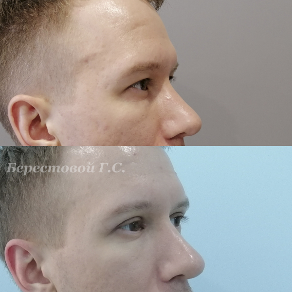 Верхняя блефаропластика (3 месяца после операции)