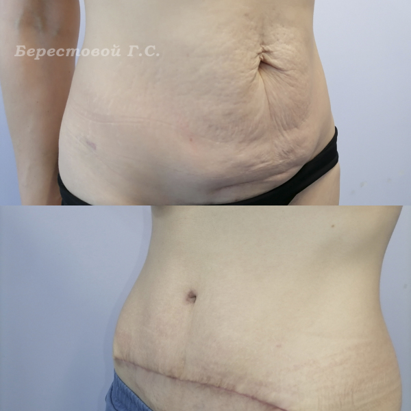 Абдоминопластика ( до и 2 месяца после операции