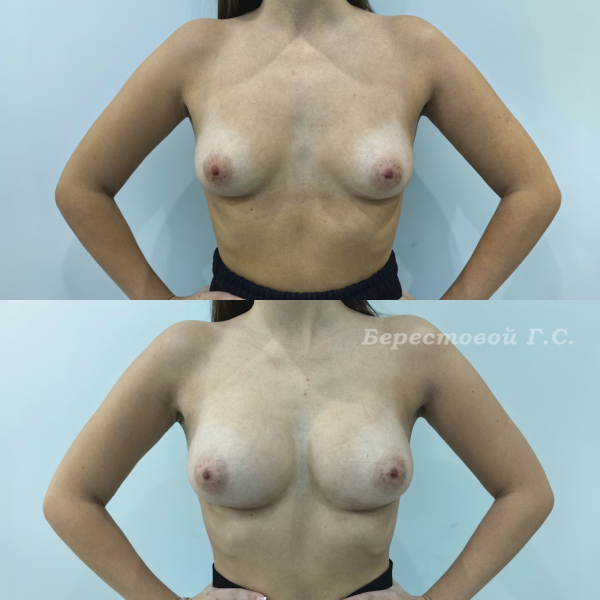 Увеличение груди круглыми имплантами