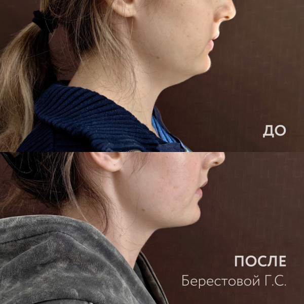 Ультразвуковая липосакция Vaser