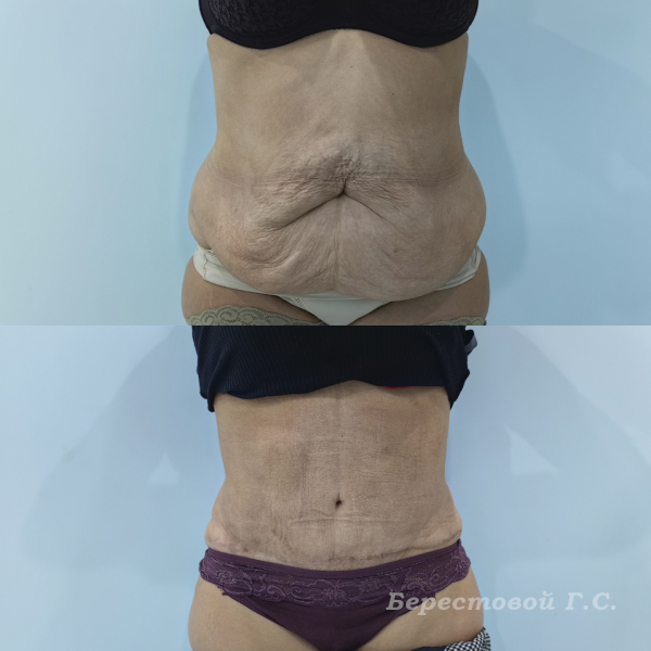 Абдоминопластика