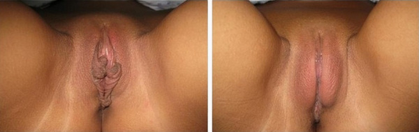 Интимная пластика Ставрополь