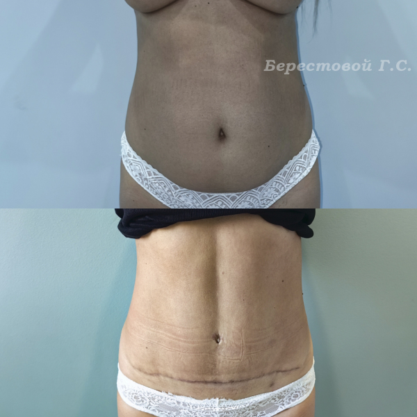 Абдоминопластика + Vaser липосакция
