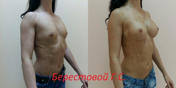 Увеличение груди анатомическими имплантами